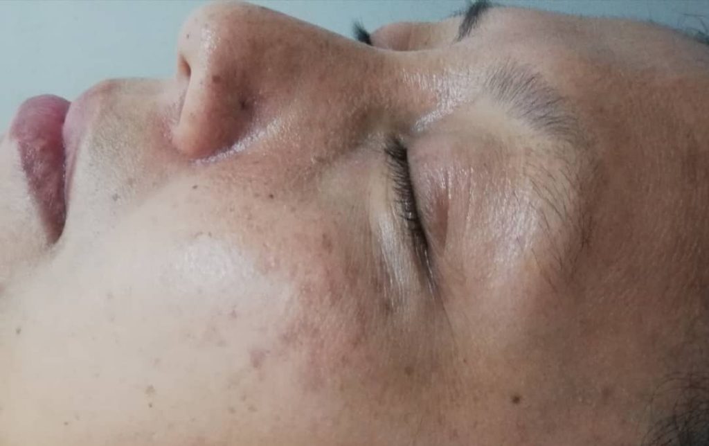 Sebelum rawatan Vitamin C Quenching