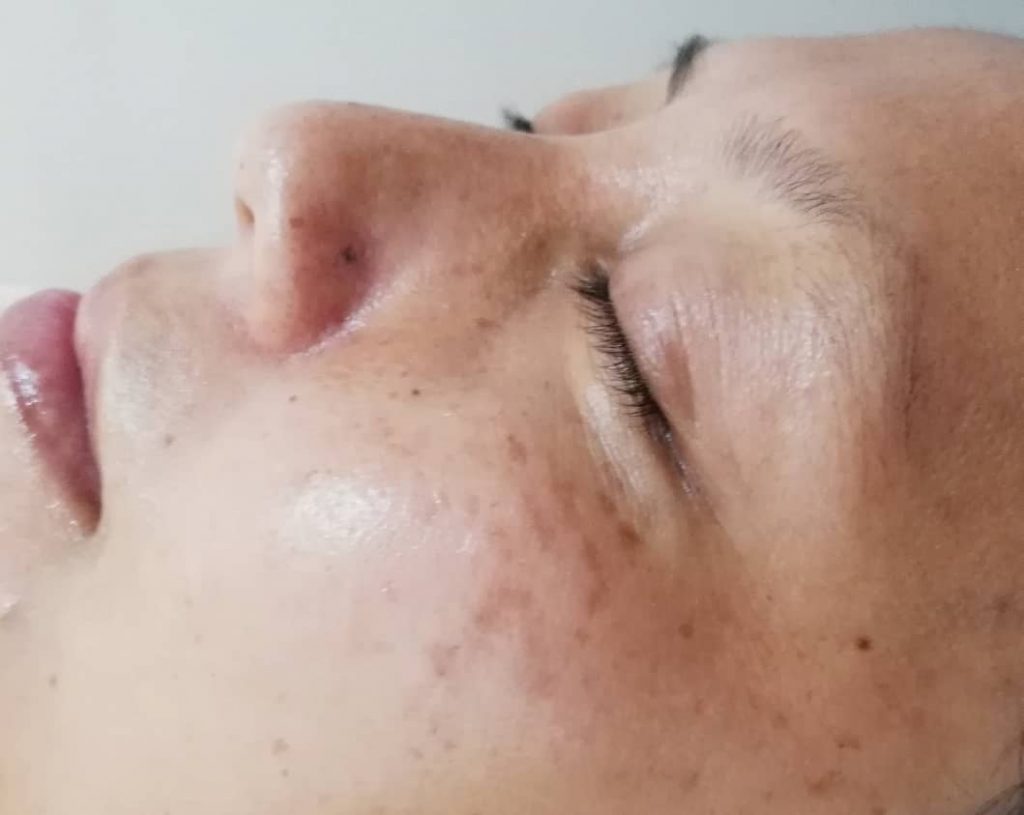 Selepas rawatan Vitamin C Quenching...